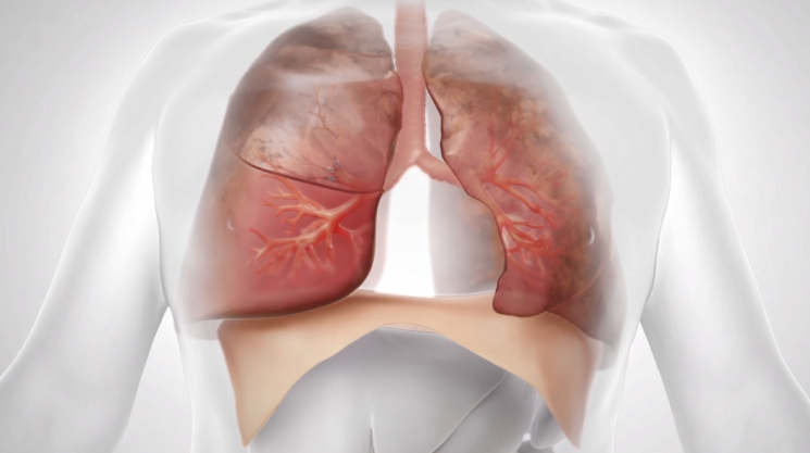 lung-20201231_g12.jpg