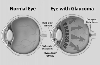 f-eyewithglaucomaa02.jpg