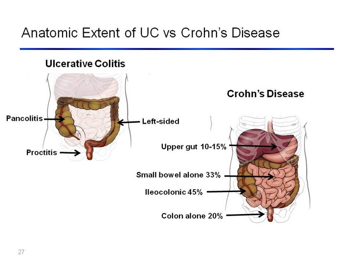 Anatomic Extent Of Uc Vs Crohns Disease Ulcerative Colitis Crohns 4587