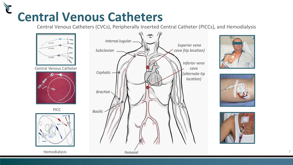 7 Central Venous Catheters Central Venous Catheters (CVCs ...