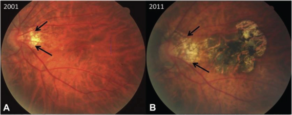 [MISSING IMAGE: tv524860_img-macular.jpg]